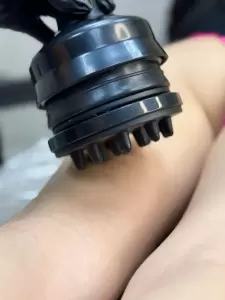 Фотография Laserskin 2