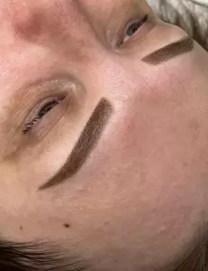 Фотография Laserskin 4